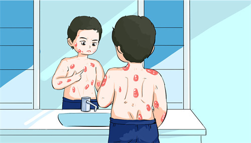 银屑病的发作与什么有关